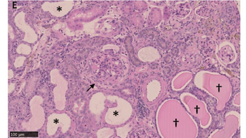 Nephrotic syndrome resulting from a mutation in Lama5